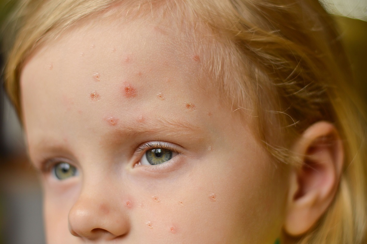 Crianças são afetadas pela varíola dos macacos | Foto: Irina Starikova3432/Shutterstock