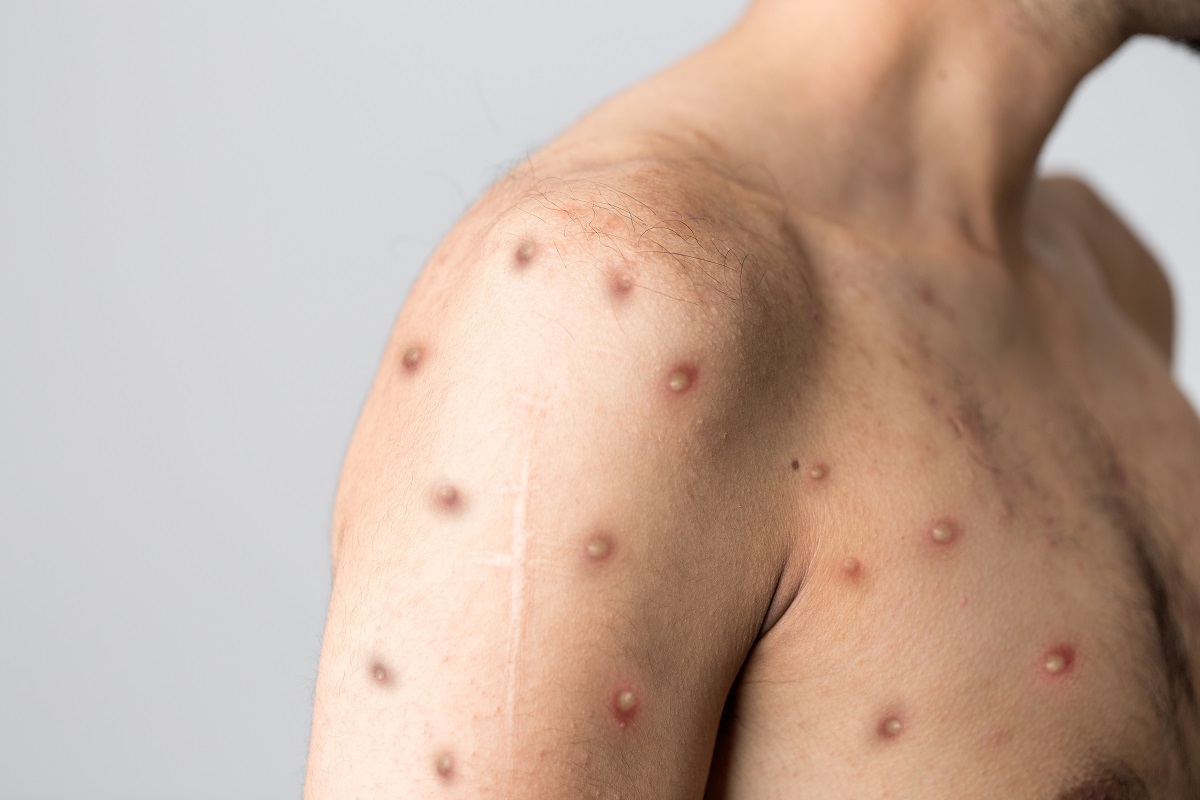 Qualquer pessoa pode contrair varíola dos macacos | Foto: Berkay Ataseven/Shutterstock
